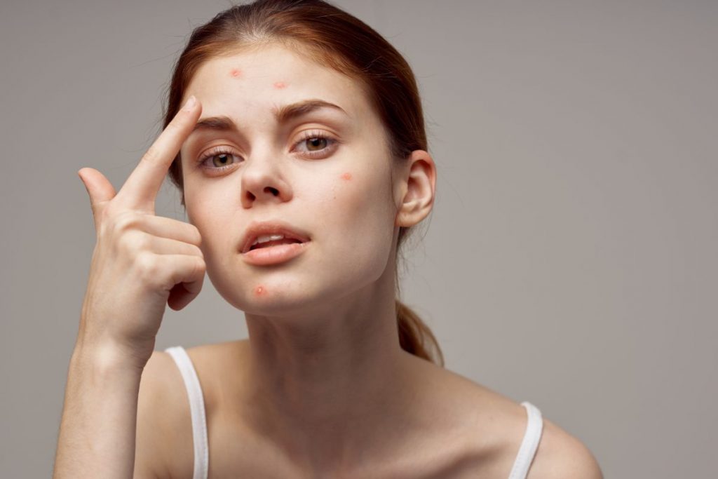 pele-oleosa-acne-blog-delas
